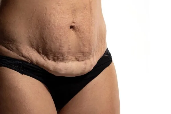 The Science of Skin Tightening 1 The science behind skin tightening Swindon picture of a woman's sagging skin on the stomach